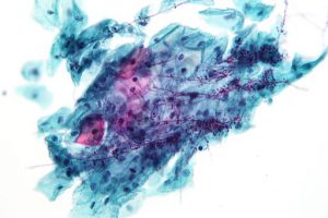 home-cure-for-yeast-infection